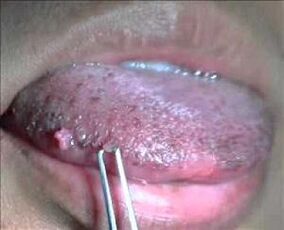 virus du papillome humain sur la langue
