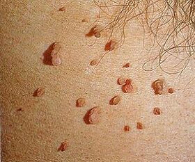 virus du papillome humain sur la peau