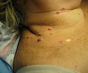 virus du papillome humain sur le cou