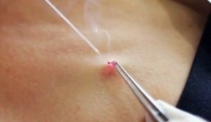 Élimination des papillomes sur le corps au laser. 
